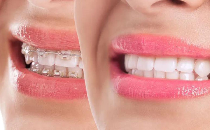 齙牙矯正大概需要花費多少錢？齙牙矯正可以改善凸嘴嗎？