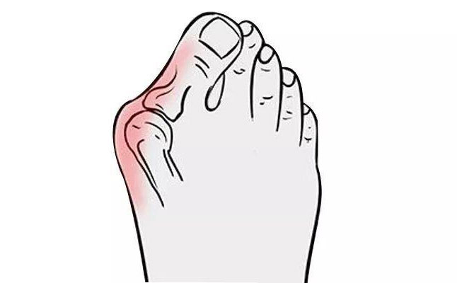 大腳骨矯正手術(shù)多少錢(qián)？大腳骨矯正三個(gè)月可以恢復(fù)嗎？