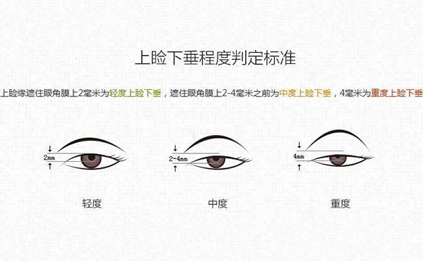 上瞼下垂一定要做嗎?上瞼下垂修復效果好嗎?
