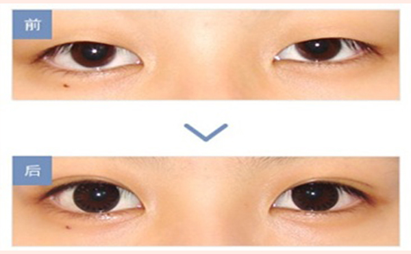 如何判斷真假性上瞼下垂?上瞼下垂做雙眼皮可以改變嗎?