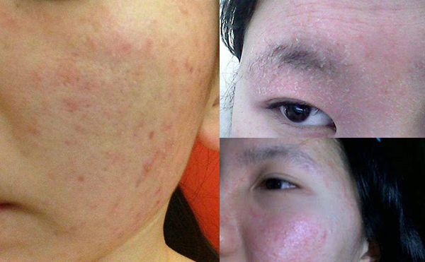 果酸煥膚有哪些風(fēng)險和弊端？