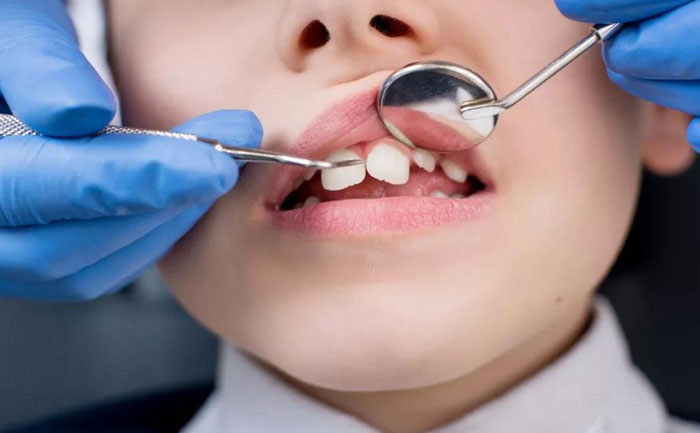 小孩牙齒矯正最佳年齡？小孩牙齒矯正價格多少錢？