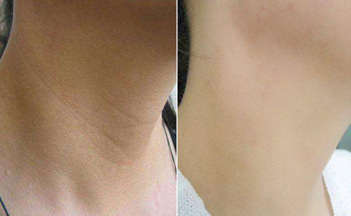 嗨體去頸紋效果怎么樣？