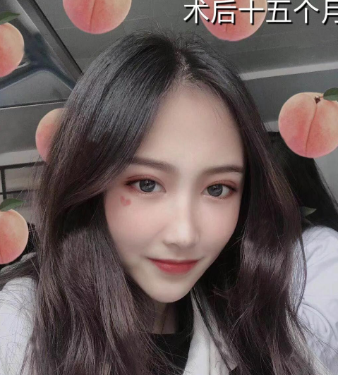 微創(chuàng)雙眼皮術(shù)后十五個(gè)月效果