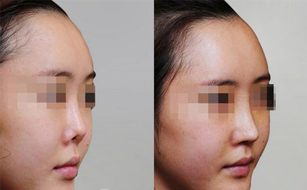 修復后的鼻翼缺損是否真實？