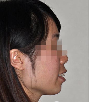 只有青年人才適合正畸