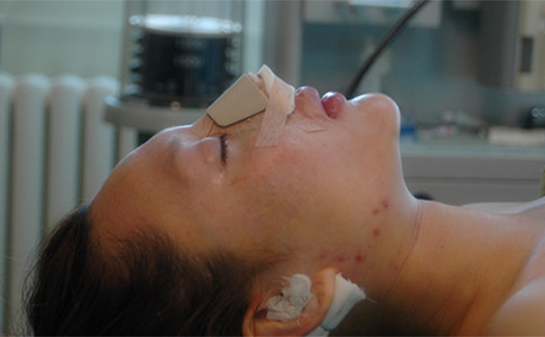 隆鼻假體取出容易嗎