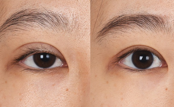 眼部修復風險大嗎？眼修復價格是多少？