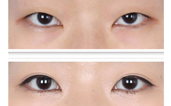 瞼松弛矯正適應(yīng)癥是什么?術(shù)后怎么護理?