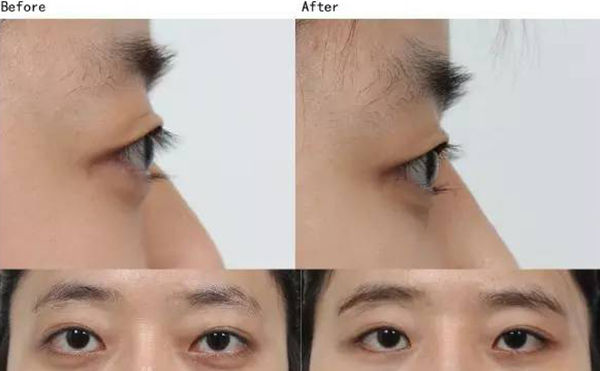 哪些人適合做眼球突出矯正?先天性突眼怎么辦?