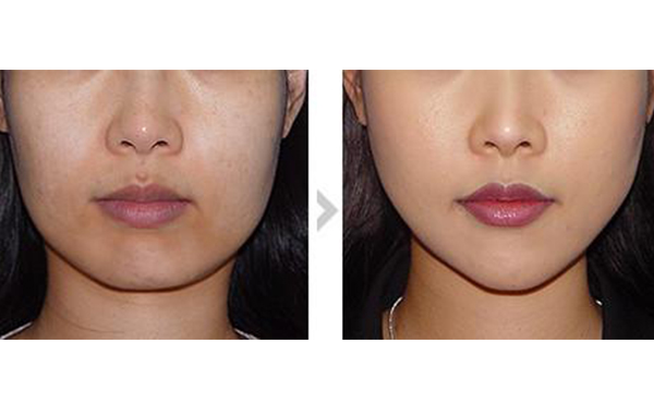 面部吸脂可以多次進行嗎？