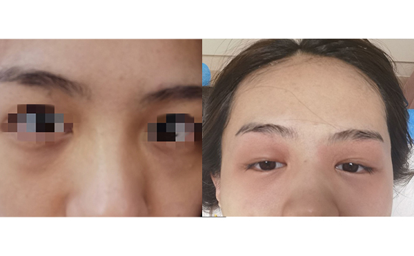 光子嫩膚去黑眼圈怎么樣？