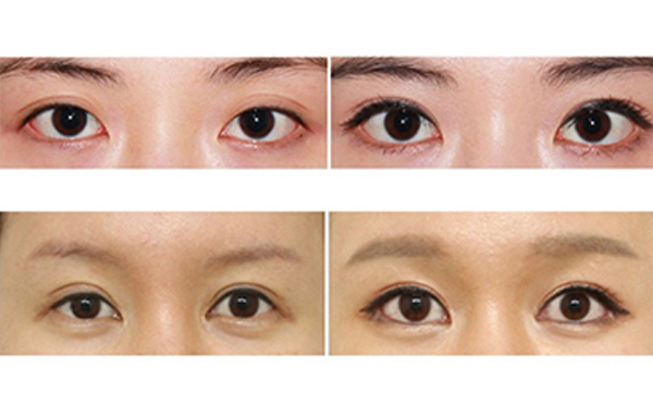 為什么醫(yī)生不建議開外眼角？