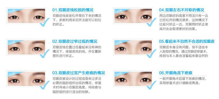 雙眼皮修復(fù)手術(shù)成功率高嗎？雙眼皮修復(fù)的最佳時間