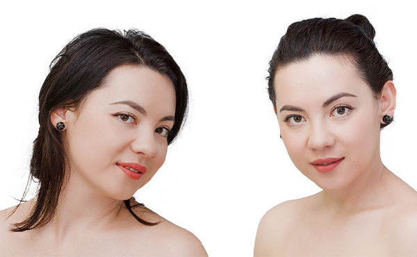 什么是蘋果肌?哪些人適合填充蘋果肌?