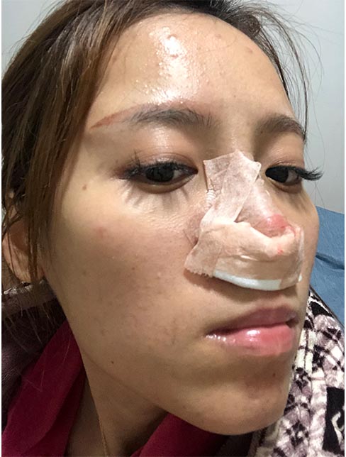 肋軟骨鼻綜合案例：恢復(fù)期效果