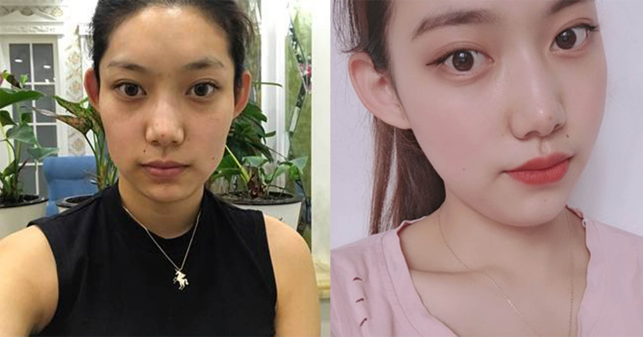 脂肪填充手術(shù)效果對(duì)比4