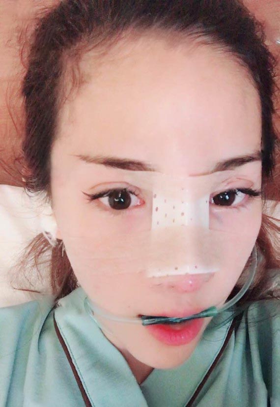 洛陽醫(yī)生隆鼻效果