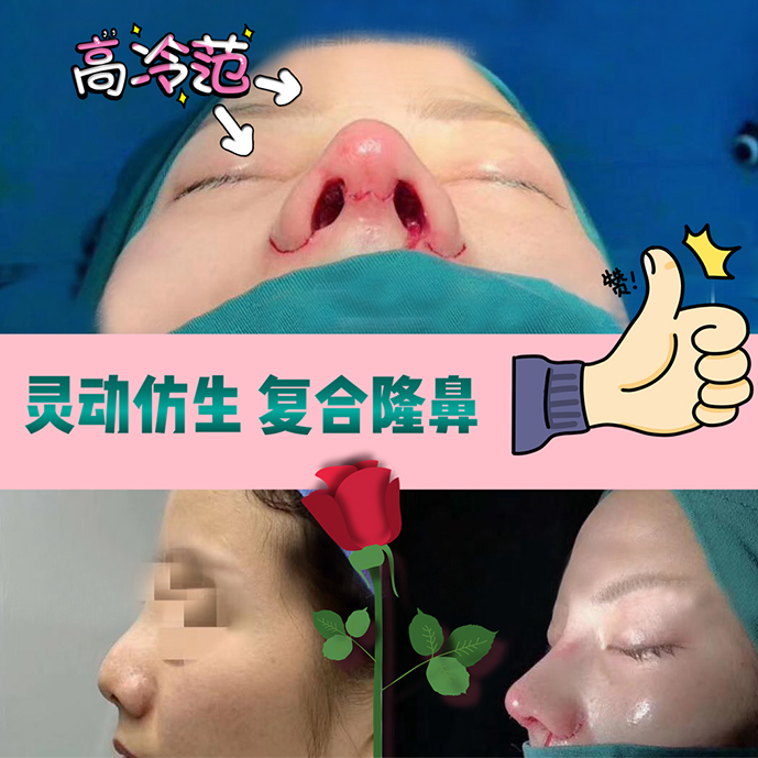 自體肋骨鼻修復(fù)效果