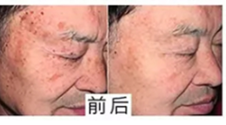 華韓醫(yī)療美容醫(yī)院祛斑案例對比