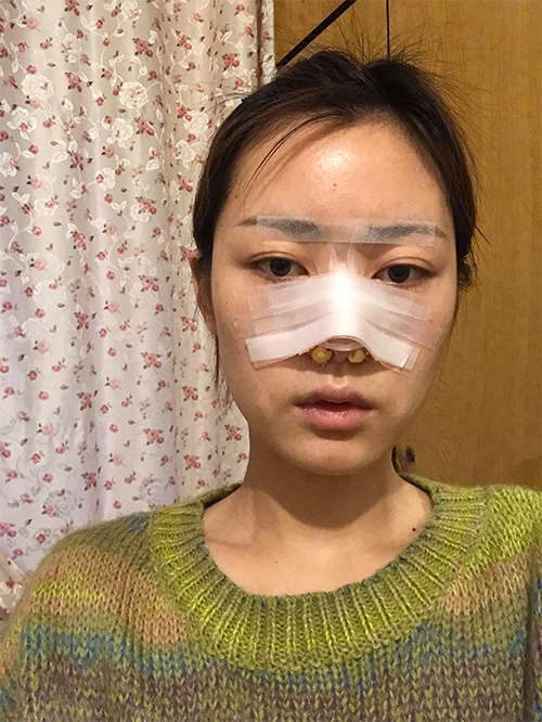 天津伊美爾超肋鼻綜合案例一周效果圖