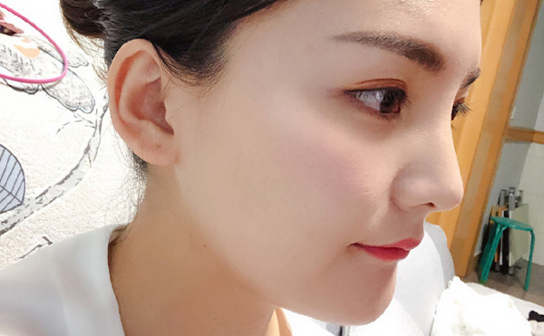 石家莊藍山杜建龍醫(yī)生下頜角整容手術案例一年