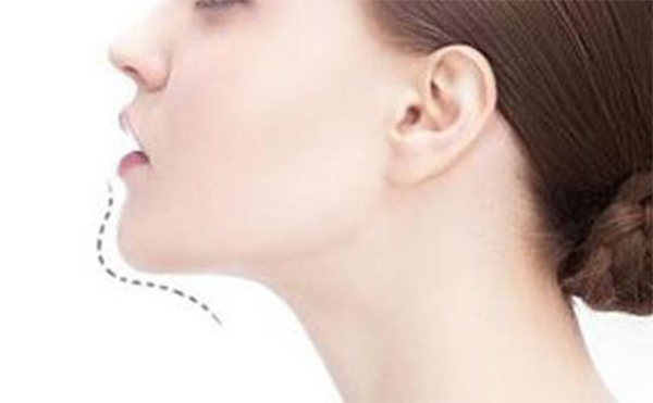 玻尿酸豐下巴好嗎？做玻尿酸豐下巴需要注意什么