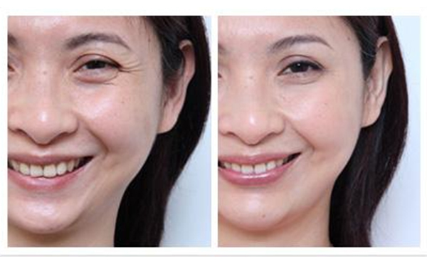 去魚(yú)尾紋多少錢(qián)？