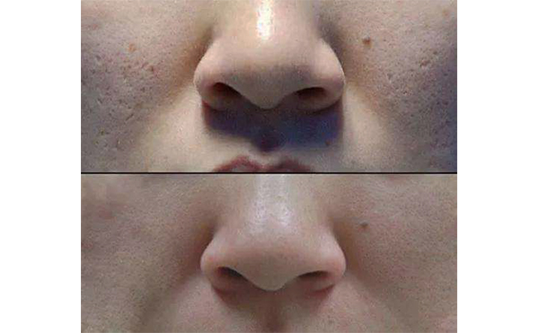 光子嫩膚適合哪個年齡段？