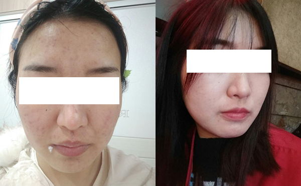 美白針可以維持多久？