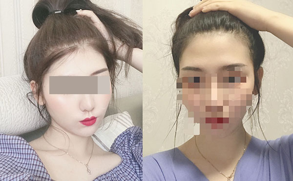 冰點(diǎn)脫毛后多久可以洗澡嗎？