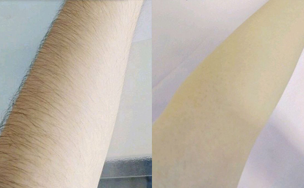 光子脫毛有疼痛感嗎？