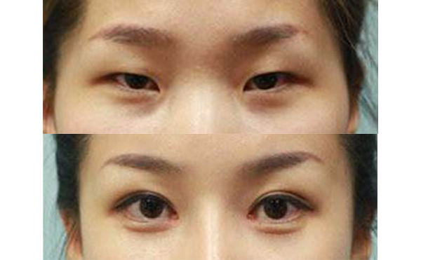 眼綜合手術(shù)多久能恢復(fù)自然？