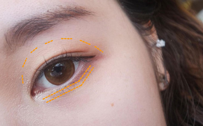 眼窩自體脂肪填充多少錢？自體脂肪豐眼窩成活率高嗎？