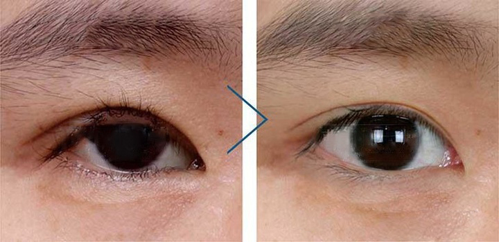 雙眼皮術(shù)后為什么出現(xiàn)眼瞼外翻?該怎么修復(fù)?