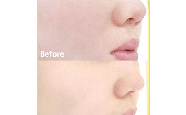 無針水光針有副作用嗎？