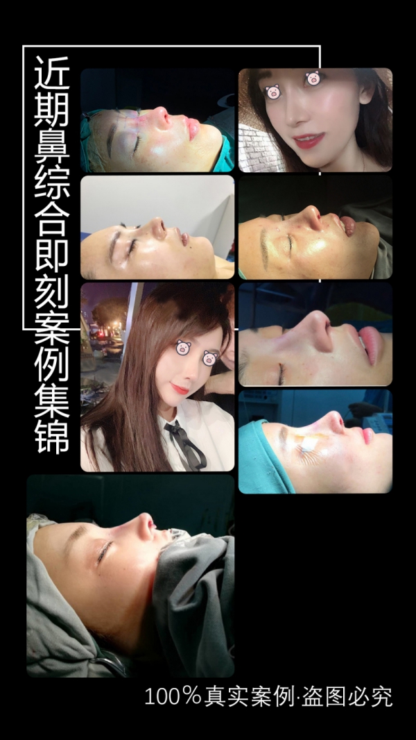隆鼻手術(shù)案例集錦