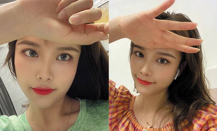 埋線提升案例效果對(duì)比圖3