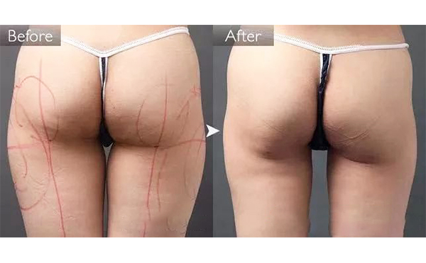 吸脂提臀過程是什么?手術有什么原則?