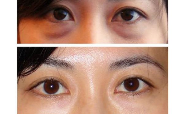 眼袋抽脂的手術(shù)過程是什么？