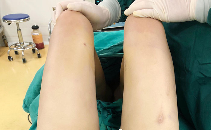 腿部吸脂手術(shù)大約多少錢？腿部吸脂多久后腿部恢復(fù)正常？