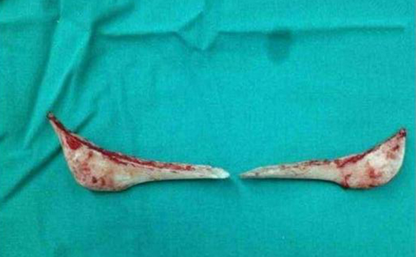 下頜角整形口內(nèi)切口和口外切口哪種方式更好？