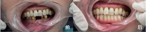 美奧種植牙案例2