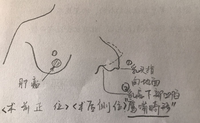 乳房畸形是什么原因造成的？乳房畸形矯正手術(shù)方法？