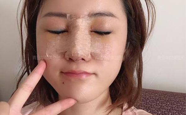 以注射隆鼻和假體隆鼻為例，如何確定隆鼻失敗