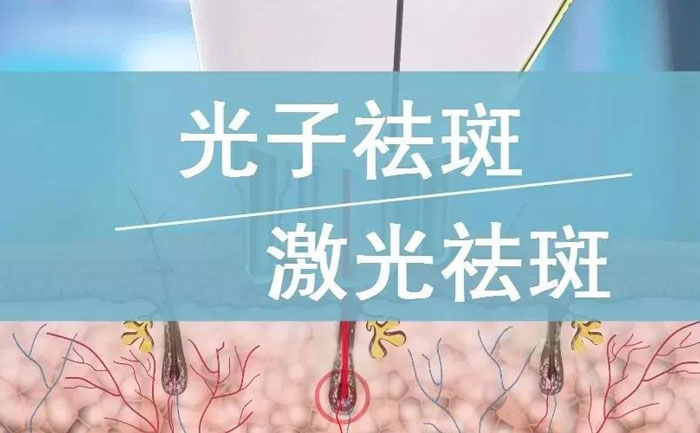 光子祛斑效果如何？