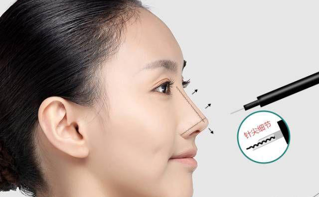 鼻部除皺的最好方法是什么？鼻部除皺多少錢？