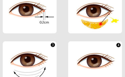 內(nèi)切眼袋怎么做？
