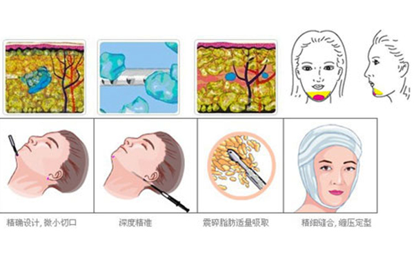 下巴整形吸脂術(shù)要多少錢(qián)？