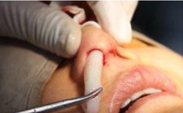 假體隆鼻術(shù)后為什么會(huì)發(fā)生假體移動(dòng)的情況？如何避免這類情況的發(fā)生